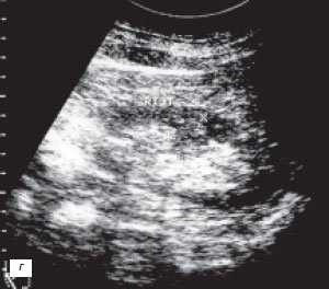 Эхограмма: псевдоопухоль - гипертрофия столба Бертена в среднем отделе правой почки