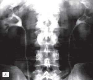 Экскреторная урограмма: псевдоопухоль - гипертрофия столба Бертена в среднем отделе правой почки