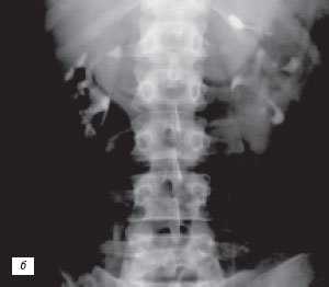 Экскреторная урограмма: псевдоопухоль - увеличенная