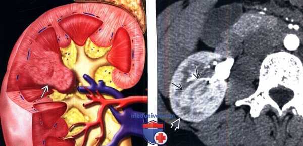 КТ, УЗИ при бертиниевых колоннах почки