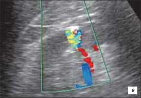 Мелкий дивертикул верхней чашечки правой почки с симптомом кальциевого молока