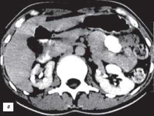 КТ с контрастным усилением: псевдоопухоль - увеличенная