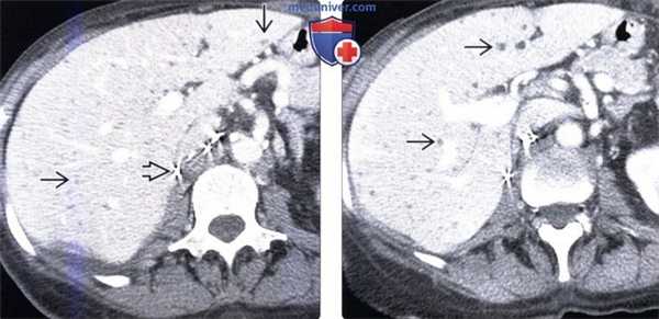 КТ, МРТ, УЗИ признаки билиарной гамартомы печени