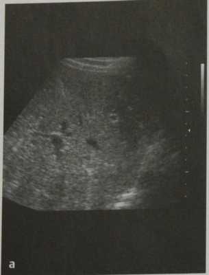 Снимки МРТ и КТ. Билиарные гамартомы (комплексы фон Мейенбурга)