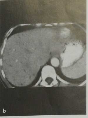 Снимки МРТ и КТ. Билиарные гамартомы (комплексы фон Мейенбурга)