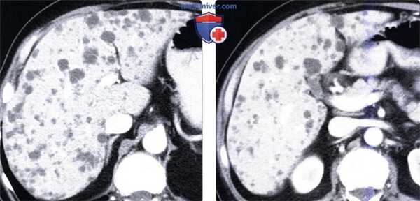 КТ, МРТ, УЗИ признаки билиарной гамартомы печени