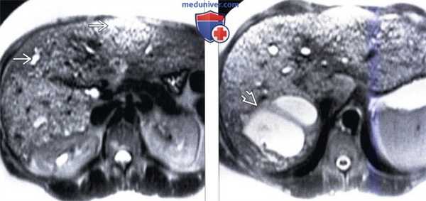 КТ, МРТ, УЗИ признаки билиарной гамартомы печени
