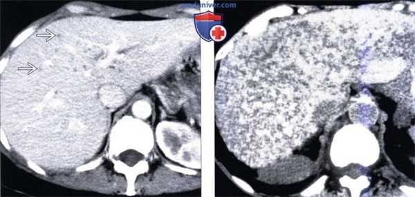 КТ, МРТ, УЗИ признаки билиарной гамартомы печени