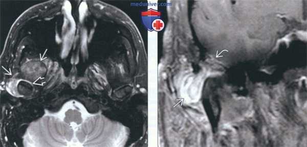 Рентгенограмма, КТ, МРТ при болезни накопления кальция пирофосфата дигидрата в височно-нижнечелюстном суставе (ВНЧС)