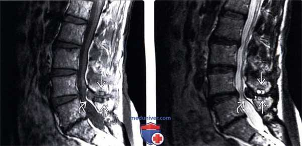 МРТ болезни Бааструпа