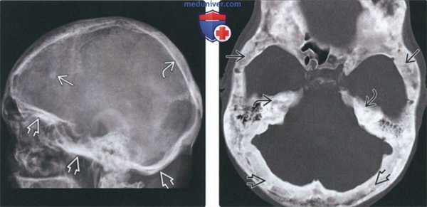 Рентгенограмма, КТ при болезни Педжета челюсти