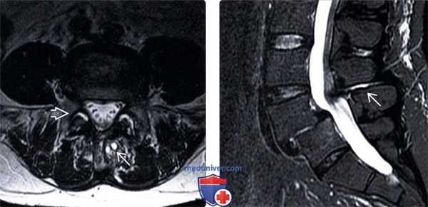 МРТ болезни Бааструпа