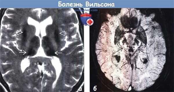 Болезнь Вильсона на МРТ головного мозга