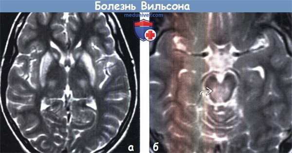 Болезнь Вильсона на МРТ головного мозга