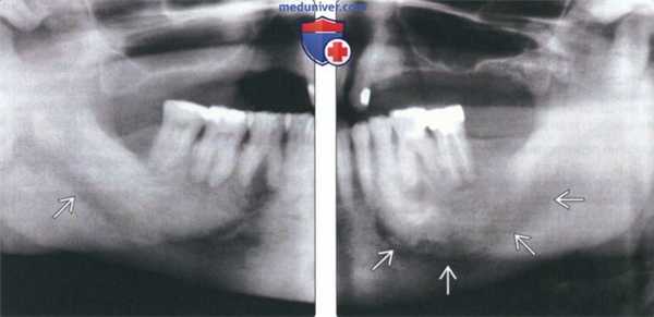 Рентгенограмма, КТ при болезни Педжета челюсти