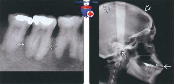 Рентгенограмма, КТ при болезни Педжета челюсти
