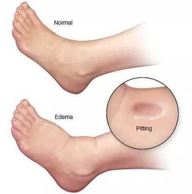 Отёк ноги при циррозе печени