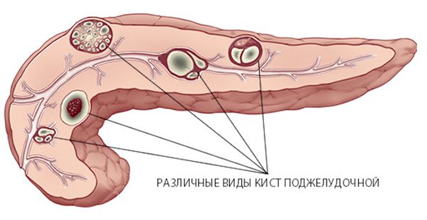 Кисты поджелудочной железы
