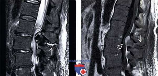 МРТ болезни Бааструпа