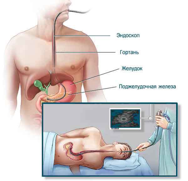 Эндосонография, или эндоУЗИ