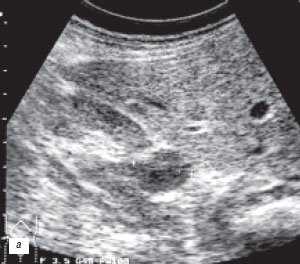 Эхограмма: псевдоопухоль - увеличенная 