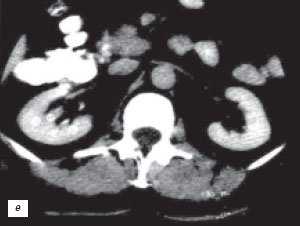 КТ с контрастным усилением: псевдоопухоль - гипертрофия столба Бертена в среднем отделе правой почки