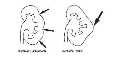 Схема: псевдоопухоли - фетальная долчатость, 