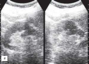 УЗИ: псевдоопухоль - горбатая левая почка