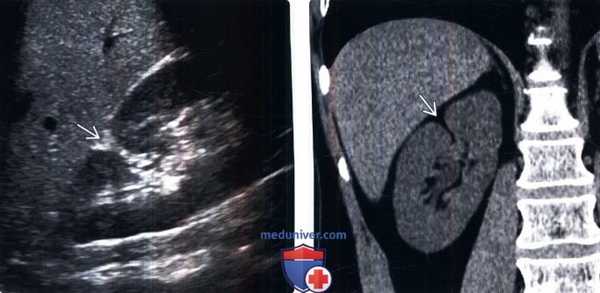 КТ, УЗИ при дефекте соединения паренхимы почки