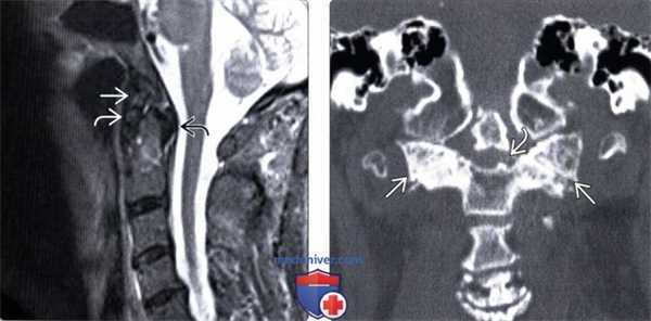 КТ дегенеративных изменений краниовертебрального сочленения
