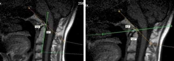 МРТ краниовертебрального перехода