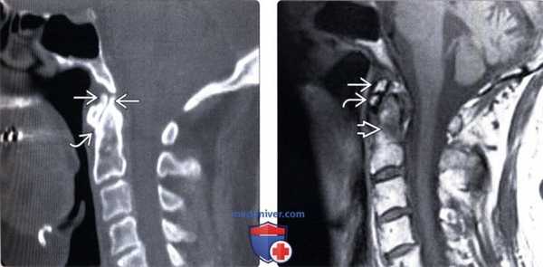 КТ дегенеративных изменений краниовертебрального сочленения