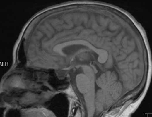 МРТ краниовертебрального перехода