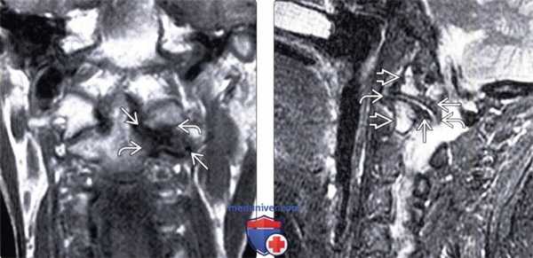КТ дегенеративных изменений краниовертебрального сочленения