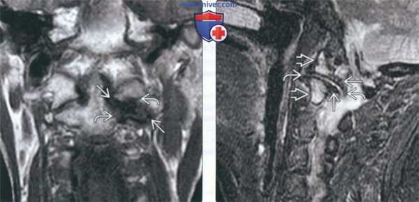 Рентгенограмма, КТ, МРТ при дегенеративном заболевании суставов кранио-вертебрального сочленения