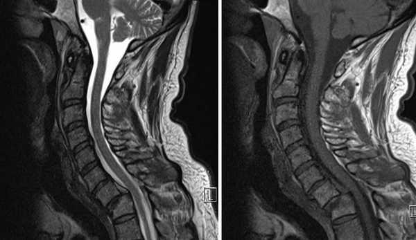МРТ шейного отдела позвоночника в сагиттальной плоскости