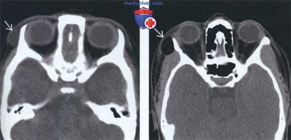 КТ, МРТ при дермоиде и эпидермоиде полости рта