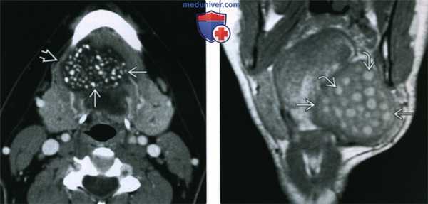 КТ, МРТ при дермоиде и эпидермоиде полости рта