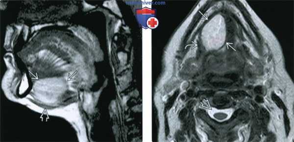 КТ, МРТ при дермоиде и эпидермоиде полости рта