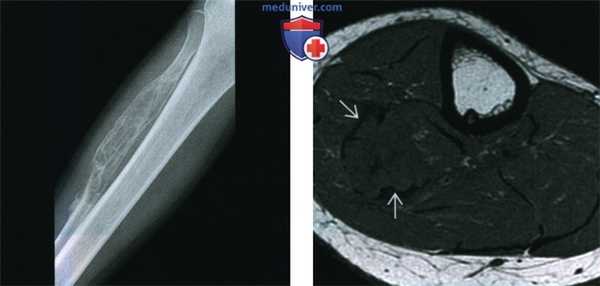 Десмопластическая фиброма - лучевая диагностика