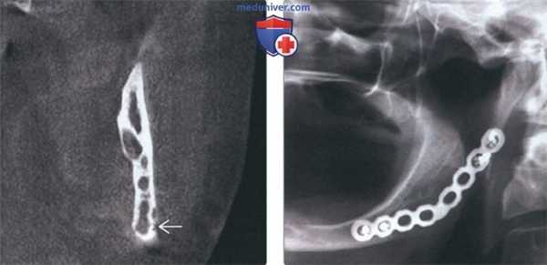 Лучевая диагностика десмопластической фибромы челюсти