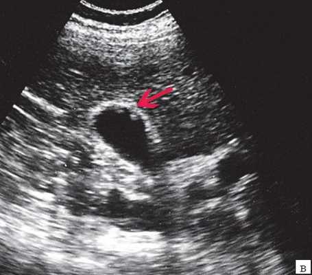 УЗ-картина полипов в желчном пузыре - полиповидно-сетчатая форма холестероза (2в)