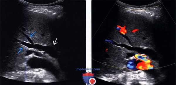 УЗИ при дилатации желчных путей