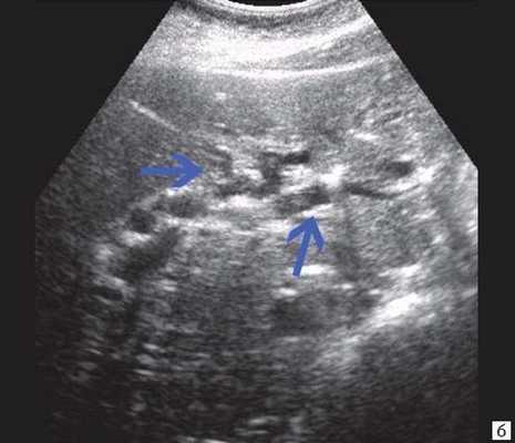 Эхограмма опухоли большого дуоденального сосочка - расширение внутрипечоночных протоков (синяя стрелка)