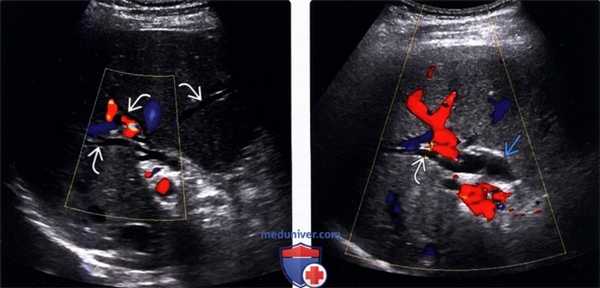 УЗИ при дилатации желчных путей