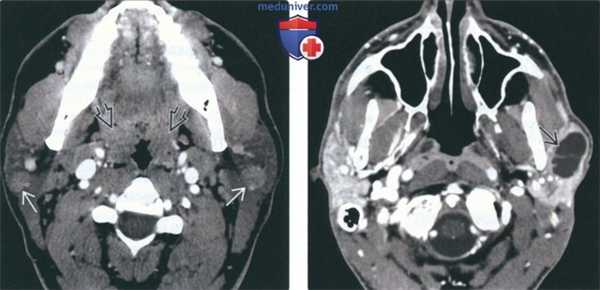 КТ, МРТ при доброкачественном лимфоэпителиальном поражении (ДЛЭП) околоушного пространства при ВИЧ