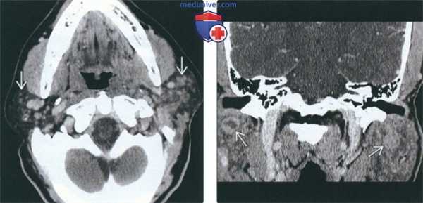КТ, МРТ при доброкачественном лимфоэпителиальном поражении (ДЛЭП) околоушного пространства при ВИЧ