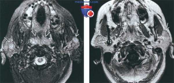 КТ, МРТ при доброкачественном лимфоэпителиальном поражении (ДЛЭП) околоушного пространства при ВИЧ