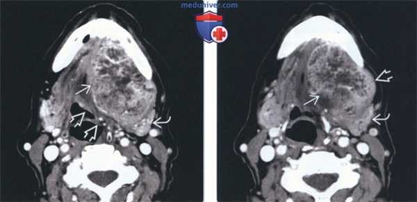 Лучевая диагностика доброкачественной смешанной опухоли подъязычной железы
