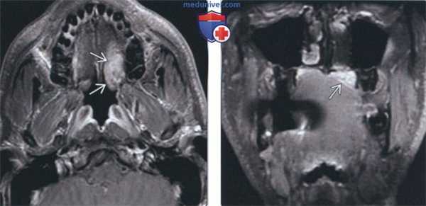 Лучевая диагностика доброкачественной смешанной опухоли неба